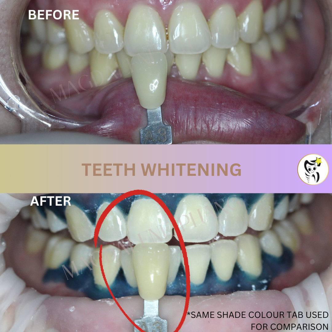 Before and After Dental Treatment